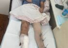 Ukrainian Swimmer Igor Chervynskiy, 3x World Championship Medalist, Injured in War with Russia